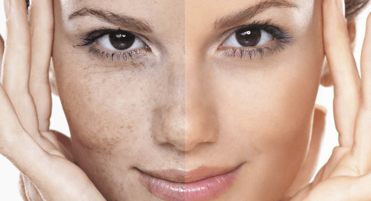 hyperpigmentation and wrinkles