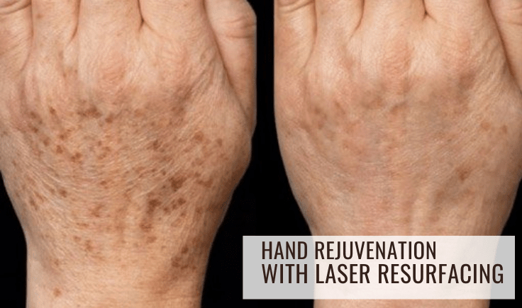 hand rejuvenation with laser resurfacing for young look and feel