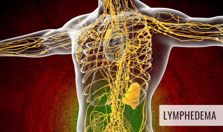 what is lymphedema