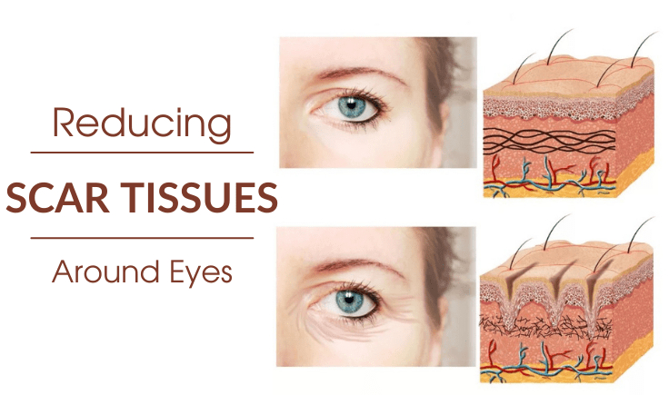 microcurrent eye treatment use#3 reducing scar tissues around eyes