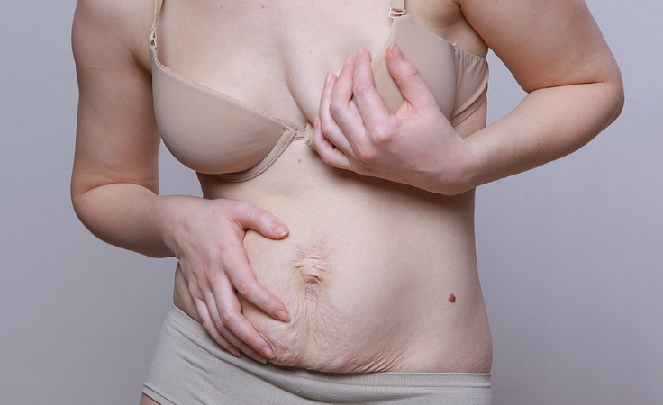 A pregnant biohacker shares sagging skin post delivery